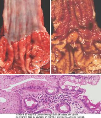 Metaplasia de Barret 22 Displasia Organização anormal das células