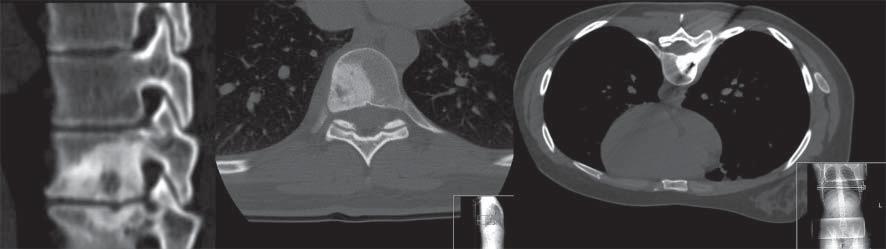 Osteoma osteoide e radiofrequência MATERIAL E MÉTODOS Entre janeiro de 2004 e maio de 2011 foram tratados 27 doentes com OO com a seguinte localização: 12 no fémur proximal (cabeça, colo e região