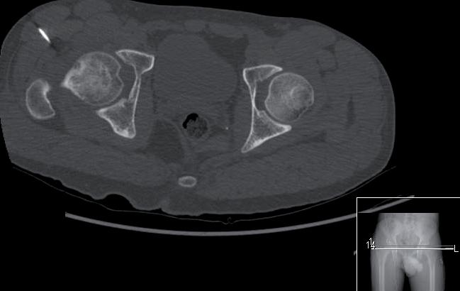 Pedro Cardoso, Maribel Gomes Figura 2. Osteoma osteoide da cabeça do fémur. Figura 4. Osteoma osteoide do colo do fémur. RESULTADOS Figura 3.