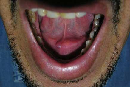 irregular, podem desencadear reação inflamatória focal na parede do ducto reforçando a obstrução salivar 5.