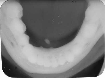 Ocorre principalmente na glândula submandibular (aproximadamente de 80% a 90% dos casos), seguida da glândula parótida (5% a 20%), sublingual (1% a 2%), raramente afetando as glândulas salivares