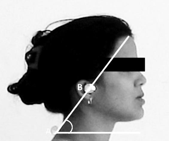 Relação entre as disfunções temporomandibulares e a postura da cabeça Introdução Estudos atuais relatam que a prevalência da Disfunção Temporomandibular (DTM) é significativamente maior em mulheres