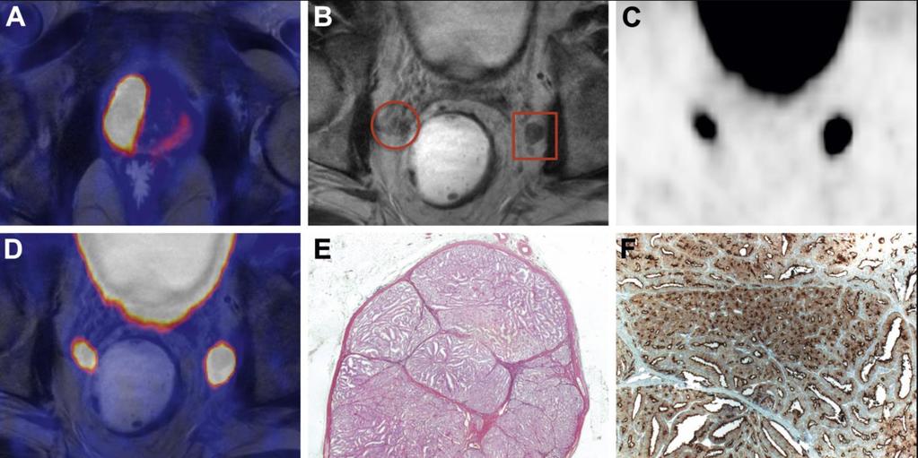 Eficácia Diagnóstica Diagnostic Efficacy of 68 Gallium-PSMA Positron Emission Tomography Compared to Conventional Imaging for Lymph