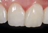 particulares 4 cores opacas de dentina proporcionam um trabalho de alta estética Casos clínicos Fratura de