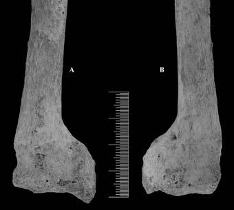 Figura 54 Fractura na extremidade distal do rádio esquerdo FP2572 proveniente das inumações secundárias da igreja de N. Sra. da Anunciada: A-Vista anterior; B-Vista posterior.