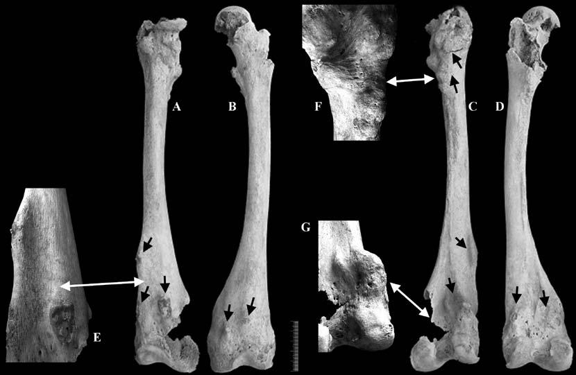 No membro inferior foram registados 80,4% (37/46) dos OC totais, sendo estes particularmente expressivos nos ossos das articulações do joelho (direito: 26,1% [12/46]; esquerdo: 15,2% [7/46]).