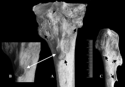 Figura 63 OC (setas) na região proximal da tibia direita [(A)- vista posterior] e área proximal da fíbula direita [(C)- vista lateral]. Pormenor do OC pedunculado da tíbia (B).