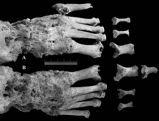 extremidade distal, bem como das áreas articulares de duas falanges e a 1ª interfalangeal.