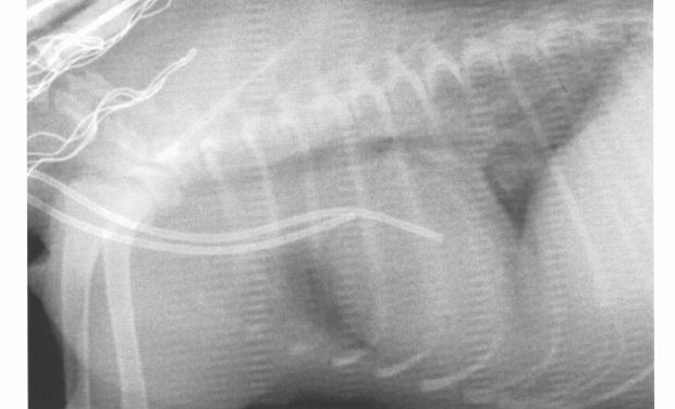 Os dois segmentos vasculares minimizam a infecção e formação de trombos Fonte: ELLIOT (2000) O dialisador (FIGURA 6) é uma unidade descartável que atua como rim artificial.