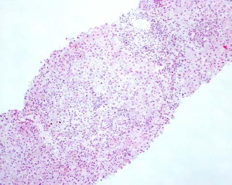 degenerescência reticular do citoplasma dos hepatócitos e arranjos pseudoacinares. Observam-se também lesões necro-inflamatórias dispersas com focos de necrose confluente.