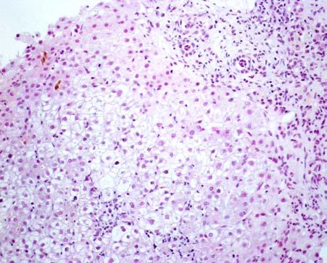 A doente teve alta orientada para a Consulta de Hepatologia, sem terapêutica anti-vírica, e às 10 semanas após o diagnóstico o PCR do ARN do VHC foi negativo.