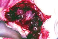 (HE-X400) FIGURA 4 Curetagem do tecido mole intra-ósseo aspecto trans-operatório.