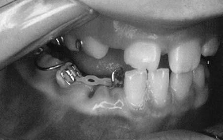 radiográfico por meio de radiografias periapicais (Fig. 6).