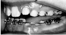 O dente em questão recebeu um bráquete, o qual serviu de apoio ao elástico em corrente