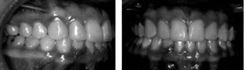 Figura 8 - Fotos intrabucais finais Discussão O tratamento da transposição dentária depende quase exclusivamente de como o caso se apresenta, podendo o ortodontista optar pelo alinhamento dos