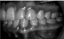 Apesar dos riscos do tratamento, que exigem do profissional uma mecânica de extremo controle, a transposição pode ser corrigida com sucesso, desde que sempre seja levado em consideração o limite