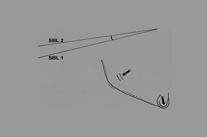 Pacientes Resumo e Métodos 50 Figura 3 Rotação real mandibular avaliada pela mudança angular entre as linhas SBL em T 0 (SBL 1) e T