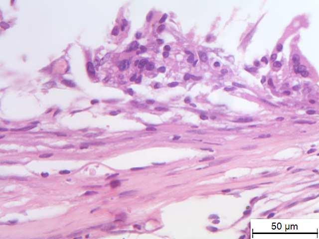 preta); Macrófagos/células gigantes (seta preta).