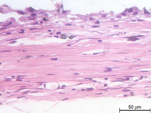 Macrófagos/células gigantes (seta preta); pontos sugestivos de
