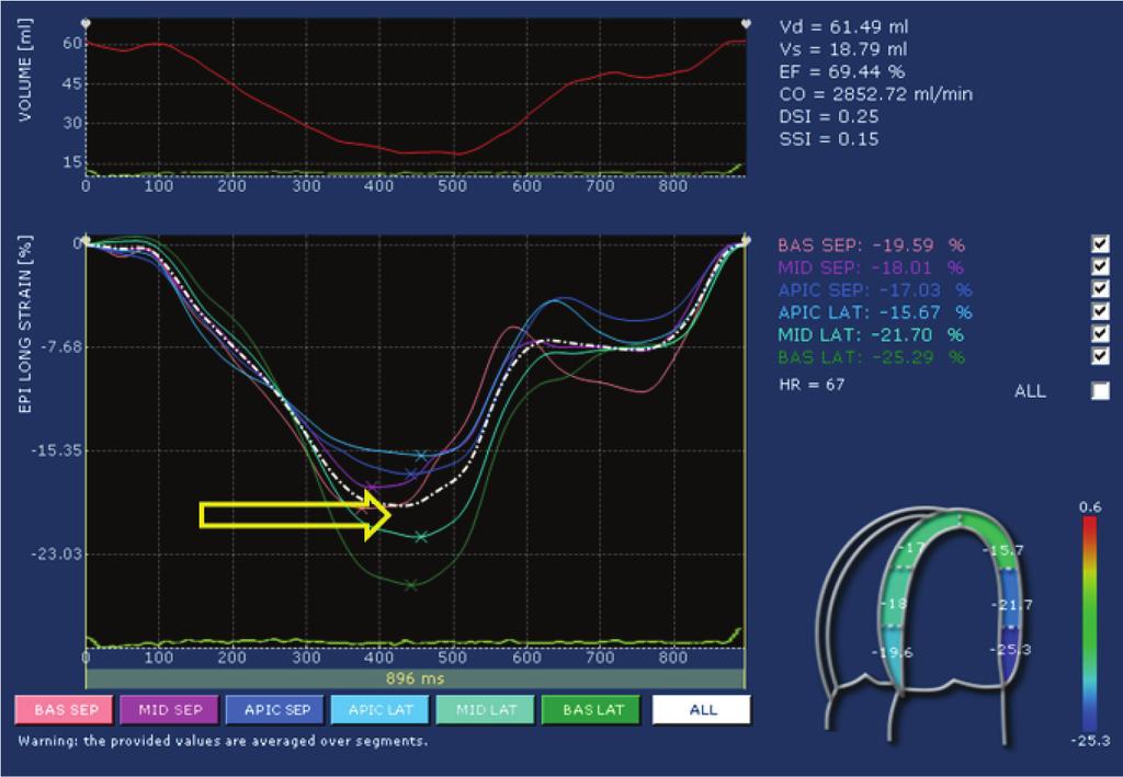 Figura 1: Imagem processada do strain bidimensional mostrando as curvas do strain derivadas de cada segmento a partir do corte apical quatro câmaras; a linha tracejada branca demonstra o strain