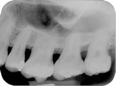 mesial 28: 3mm; até o final do defeito (Medida III), distal 27: 4mm, mesial 28, 5mm.