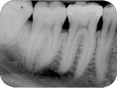 (Medida II) distal 47: 0mm, mesial 48: 0mm; até o final do defeito (Medida III), distal 47: 8mm, mesial 48: 3mm.