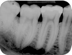 radiotransparência (Medida II) distal 47: 0mm, mesial 48: 0mm; até o final do defeito (Medida III), distal 47: 5mm, mesial 48: 4mm.