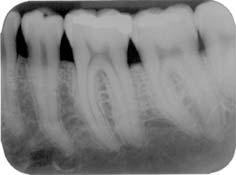 1,5mm; até o final do defeito (Medida III), distal 37: 5mm, mesial 38: 4mm.