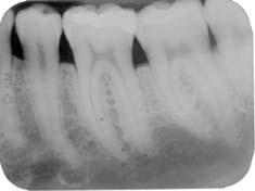 mesial 38: 1,5mm; até o final do defeito (Medida III), distal 37: 5mm, mesial 38: 3mm.