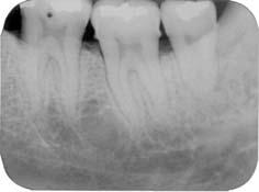 Resultados 115 PACIENTE 4 SÍTIO TESTE: MESIAL DO 36. MATERIAIS UTILIZADOS: ÁCIDO CÍTRICO, GEN-OX e GEN-DERM.