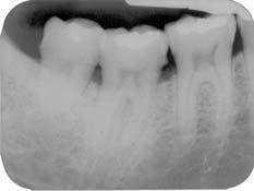 Resultados 116 SÍTIO CONTROLE: MESIAL DO 47 e DISTAL DO 46. MATERIAIS UTILIZADOS: ÁCIDO CÍTRICO e GEN-DERM.