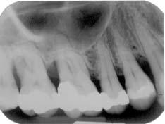 Resultados 117 PACIENTE 5 SÍTIO TESTE: MESIAL DO 14 e DISTAL DO 13. MATERIAIS UTILIZADOS: ÁCIDO CÍTRICO, GEN-OX e GEN-DERM.