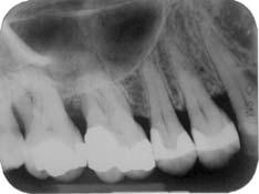 radiotransparência (Medida II) mesial 14: 2mm, distal 13: 5mm; até o final do defeito (Medida III) mesial 14: 6mm, distal 13: 5mm.