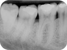 Resultados 119 PACIENTE 6 SÍTIO TESTE: DISTAL DO 46 e MESIAL DO 47. MATERIAIS UTILIZADOS: ÁCIDO CÍTRICO, GEN-OX e GEN-DERM. SÍTIO CONTROLE: DISTAL DO 47 e MESIAL DO 48.