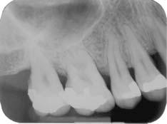 distal 15: 2mm; até o final do defeito (Medida III) mesial 16: 6mm, distal 15: 3mm.