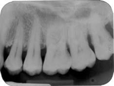 RADIOGRAFIA INICIAL Medida da Junção Cemento Esmalte até o final do Ápice (Medida I) mesial 24: 13,5mm, distal 23: 15mm; até o final da radiotransparência (Medida II) mesial 24: 4mm, distal 23: 3mm;