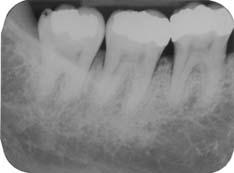 (Medida II) distal 46: 2mm, mesial 47: 0,5mm; até o final do defeito (Medida III) distal 46: 5mm, mesial 47: 3mm.