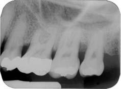 Resultados 124 SÍTIO CONTROLE: DISTAL DO 27 e MESIAL DO 28. MATERIAIS UTILIZADOS: ÁCIDO CÍTRICO e GEN-DERM.