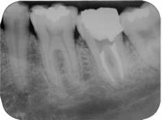 (Medida II) distal 36: 0mm, mesial 37: 2mm; até o final do defeito (Medida III) distal 36: 2,5mm, mesial 37: 0,5mm.