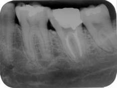 radiotransparência (Medida II) distal 36: 1,5mm, mesial 37: 0mm; até o final do defeito (Medida III) distal 36: 1mm, mesial 37: 2mm.