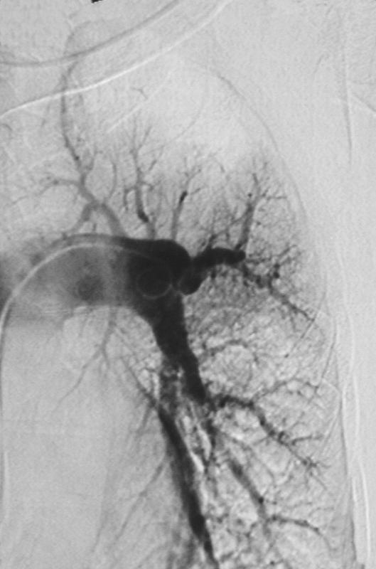 21 Figura 2: Paciente AMC. Arteriografia digital do ramo esquerdo da artéria pulmonar, com defeito de perfusão central, em ramo lobar superior, e defeito perfusional periférico no lobo inferior. 3.