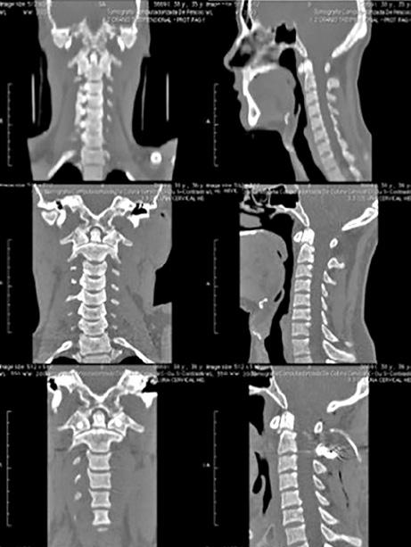 Análise retrospectiva de série de casos com lesões traumáticas da junção craniocervical 531 A C B D Pacientes que realizaram tratamento cirúrgico inicial Dois pacientes apresentaram complicações