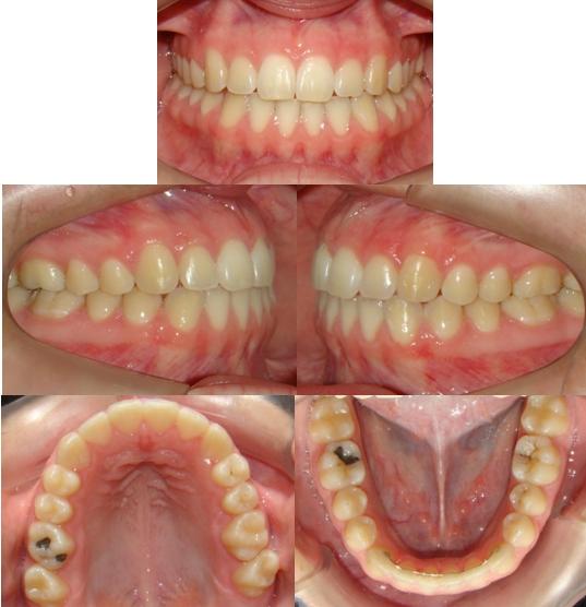 possibilite o fechamento da mordida, e consequentemente a obtenção de um trespasse vertical positivo (BELL, 1971).