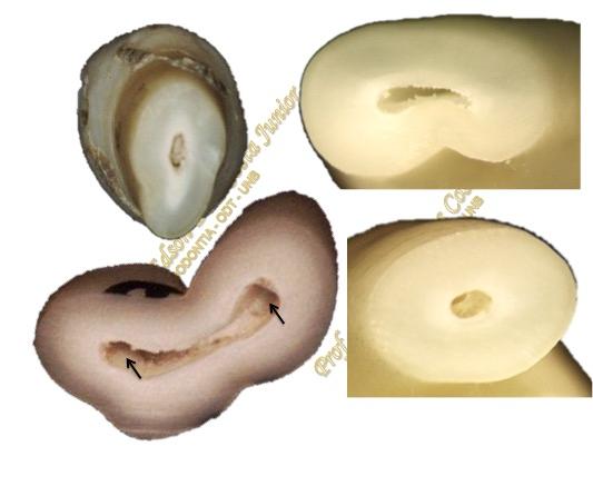 7 nestes casos, podendo existir um canal mais circular com outro mais ovalado, ambos os canais ovalados, canais que se comunicam entre si em pontos ao longo da raiz, fendas entre os canais