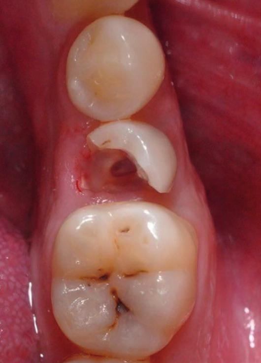 e aplicação de digluconato de clorexidina a 2%, foi aplicado no dente fraturado um material restaurador temporário (Figura 4).