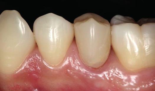 Figura 11 - Aspecto imediato após a cimentação do provisório. Figura 15 - Sondagem periodontal com evidência da saúde do periodonto. Figura 12 - Visão oclusal do provisório.