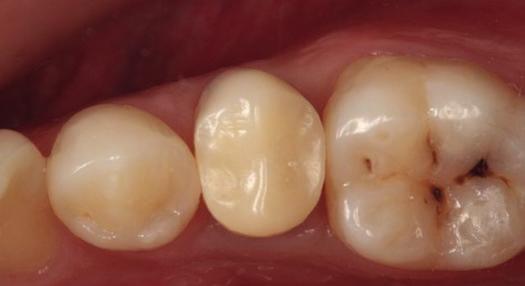 DISCUSSÃO O conhecimento das dimensões biológicas do periodonto leva-nos a concordar que a preservação do espaço biológico é fundamental para a saúde dos tecidos periodontais, especialmente quando as