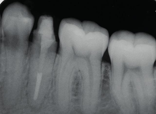 A violação deste espaço biológico vai resultar em uma inflamação progressiva, onde o organismo, em detrimento de uma reabsorção óssea, promoverá o restabelecimento destas dimensões invadidas 3,12,13.