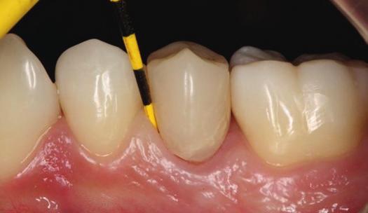 A fratura de um dente abaixo da inserção gengival ou ao nível da crista óssea alveolar apresenta um problema restaurador de difícil resolução 4,6,7,10.