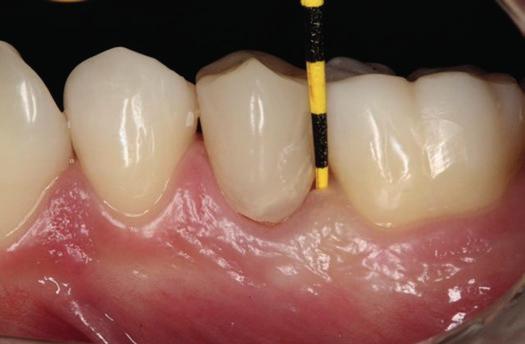 A técnica de tracionamento dental quando bem indicada proporciona um efeito estético mais favorável do que a cirurgia de aumento de coroa clínica, que impõe um sacrifício ósseo pela redução de